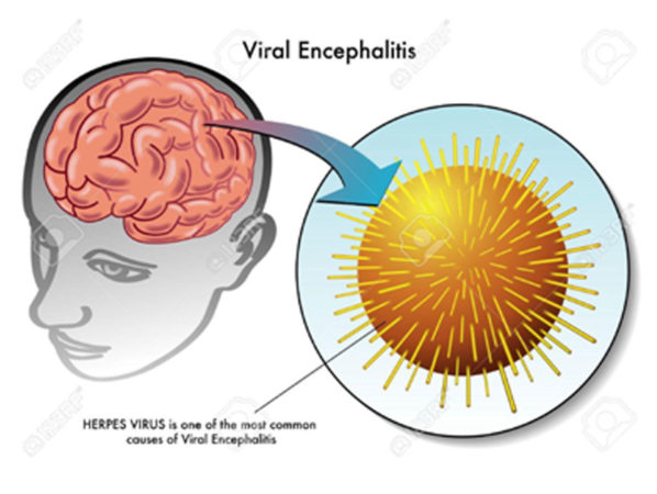 Encephalitis