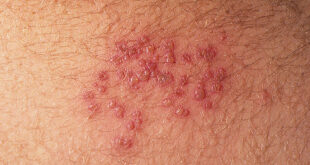How to Treat Genital Herpes