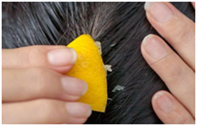Lemon helps in providing relief from itchy scalp and keeps scalp healthy