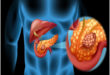 What is Pancreatic cancer