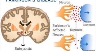 Incidence Of Parkinson's disease