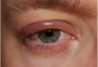 What is Chalazion