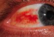 Home Remedies for Burst Blood Vessels in Eyes