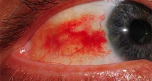 Home Remedies for Burst Blood Vessels in Eyes