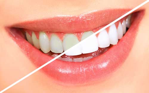 Dos and Don’ts to Brighten your Teeth