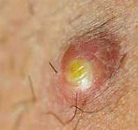 causes infected ingrown hair on labia