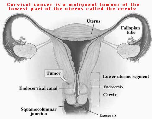 cervical cancer cervix