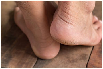 Castor oil has moisturizing properties that helps in healing cracked heels