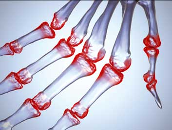 Krill oil prevents the joint pains caused by arthritis