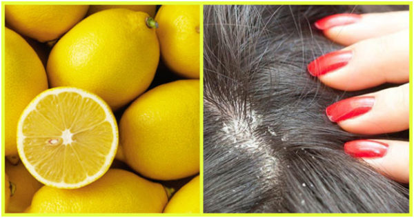 Lemon is anti-dandruff