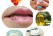 How to get Rid of Oral Herpes