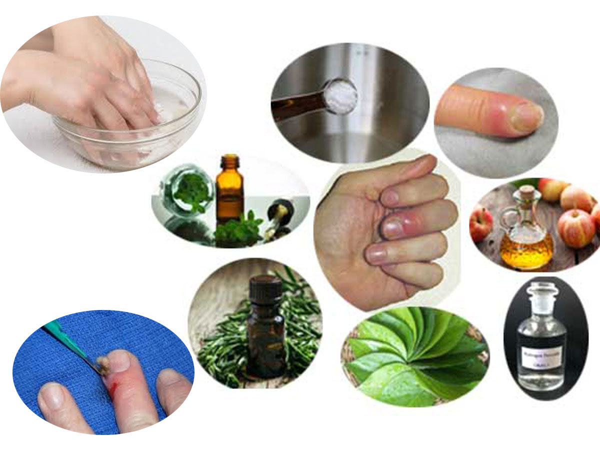 Paronychia: Types, Causes, Signs & Symptoms, Treatment & Home Remedies