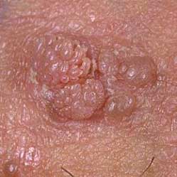 What are the Symptoms Of Genital Warts