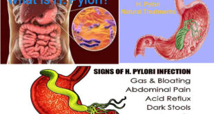 H-pylori (Helicobacter pylori)