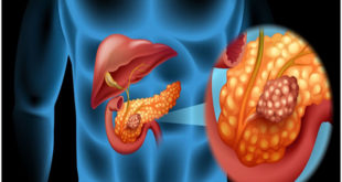What is Pancreatic cancer