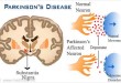 Incidence Of Parkinson's disease