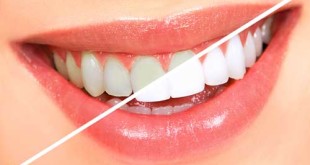Dos and Don’ts to Brighten your Teeth