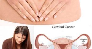 Cervical Cancer: Risk Factors, Symptoms, and Prevention