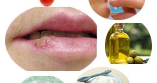 Home Remedies for Oral Herpes