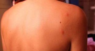 Top Home Remedies for Bug Bites